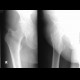 Fracture of the greater tronchanter: X-ray - Plain radiograph